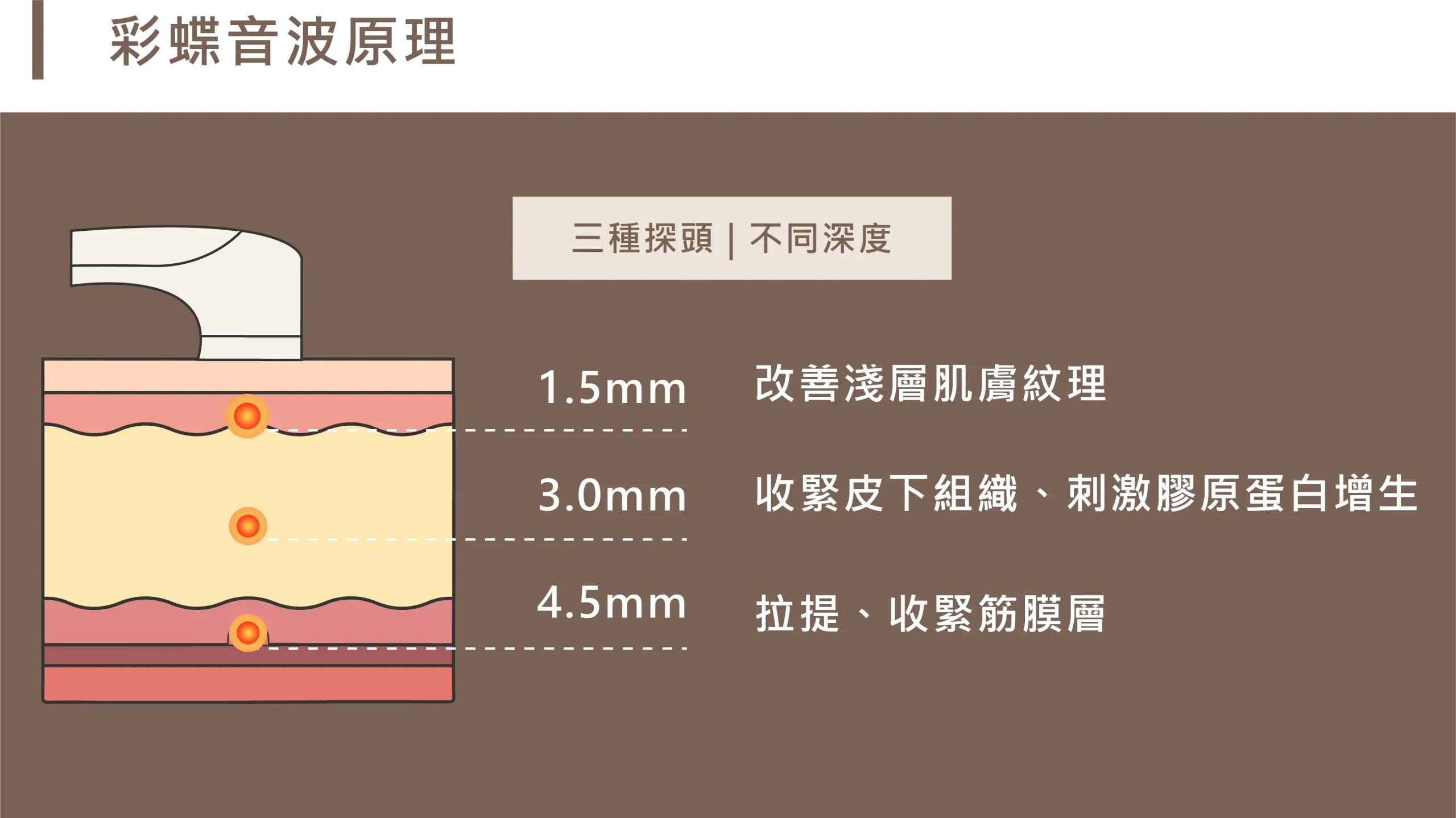 彩蝶音波三種探頭治療原理深度圖：1.5mm 探頭改善淺層肌膚紋理、3.0mm 探頭收緊皮下組織並刺激膠原蛋白增生、4.5mm 探頭則針對筋膜層進行拉提與收緊。
