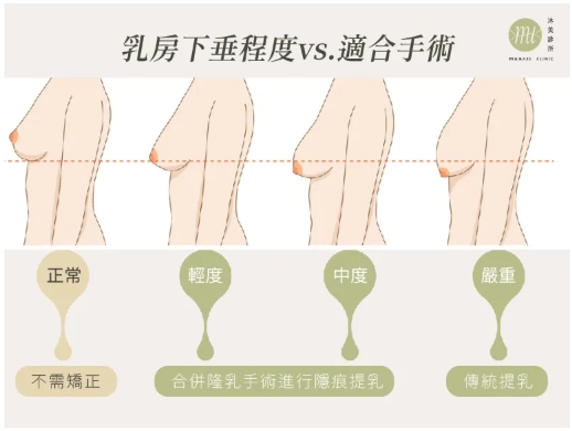 乳房下垂程度與適合手術對照圖。正常胸型不需矯正；輕度與中度下垂可合併隆乳手術進行隱痕提乳；嚴重下垂則建議採用傳統提乳手術。